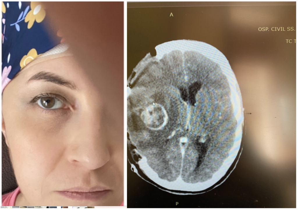 Ada and her Glioblastoma